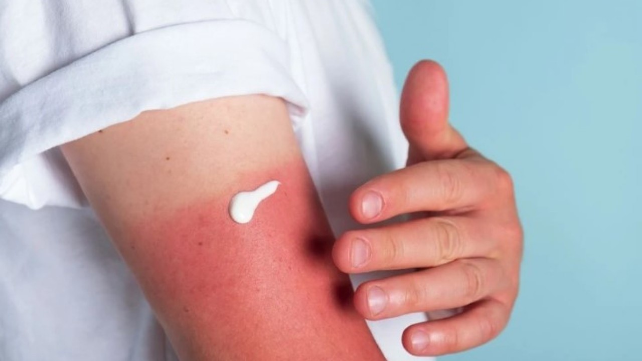 Foto - Sıcak havaların korkulu rüyası! Güneş yanığından kurtulmanın doğal yolu açıklandı