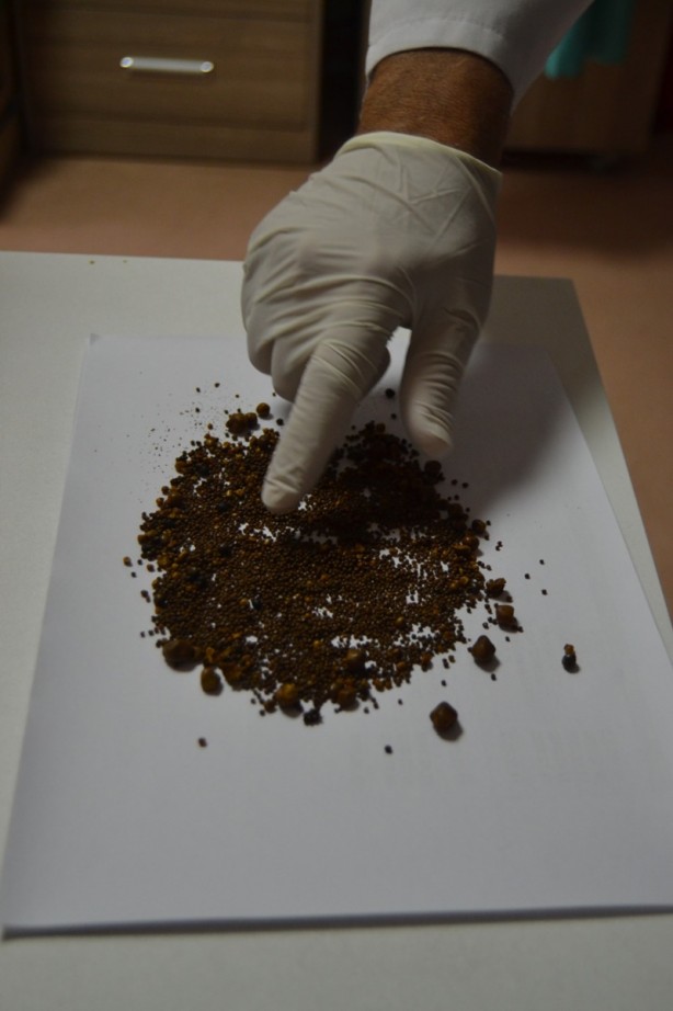 Foto - Şiddetli karın ağrısı şikayetiyle gitti! 4 bin 536 tane çıkarıldı