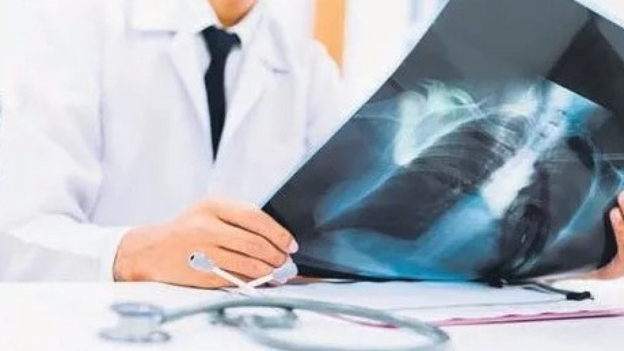 Foto - Sigara içmeyenlerde akciğer kanseri neden görülüyor? Uzman isim açıkladı