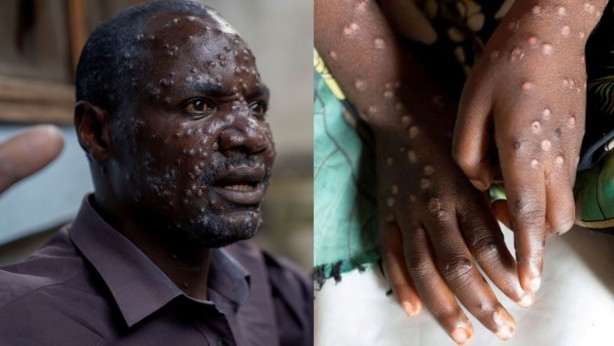 Foto - Simpsonlar'da dehşete düşüren maymun çiçeği virüsü sahnesi! İşte şimdi gerçekten yandık