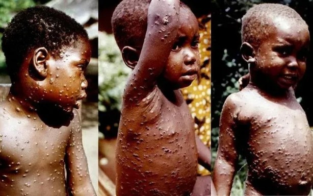 Foto - Simpsonlar'da dehşete düşüren maymun çiçeği virüsü sahnesi! İşte şimdi gerçekten yandık