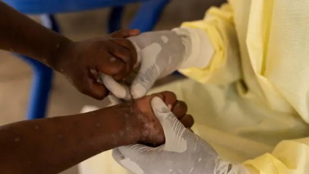 Foto - Simpsonlar'da dehşete düşüren maymun çiçeği virüsü sahnesi! İşte şimdi gerçekten yandık