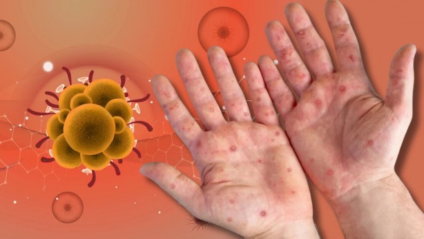 Foto - Simpsonlar'da dehşete düşüren maymun çiçeği virüsü sahnesi! İşte şimdi gerçekten yandık