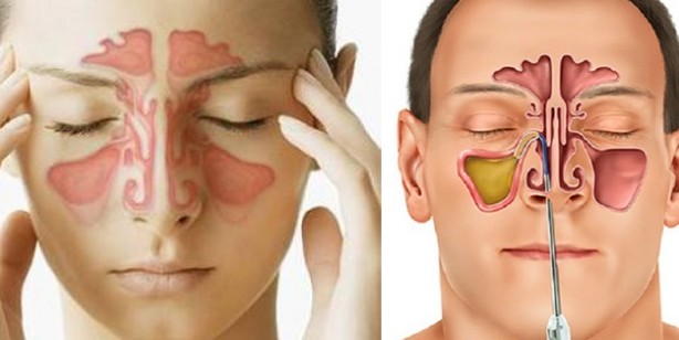 Foto - Sinüzit tedavisinde himalaya tuzunun faydası nedir? Astım belirtileri ve doğal kaya tuzu nasıl anlaşılır?