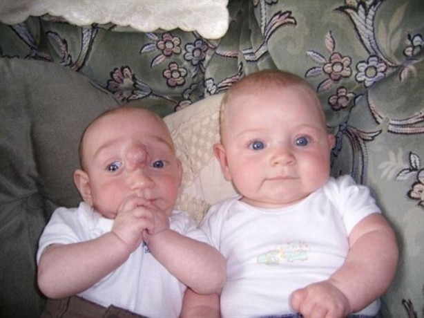 Foto - Sıra dışı olay! Beyni dışarıda doğdu!