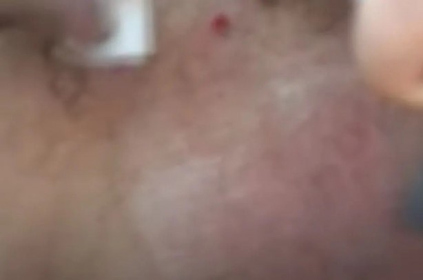 Foto - Sırtından çıkanlar görenleri şaşkına çevirdi! Sivilce zannettiği yaradan bakın ne çıktı