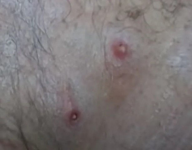 Foto - Sırtından çıkanlar görenleri şaşkına çevirdi! Sivilce zannettiği yaradan bakın ne çıktı