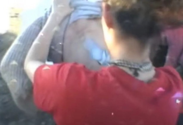 Foto - Sırtından çıkanlar görenleri şaşkına çevirdi! Sivilce zannettiği yaradan bakın ne çıktı