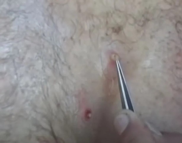 Foto - Sırtından çıkanlar görenleri şaşkına çevirdi! Sivilce zannettiği yaradan bakın ne çıktı