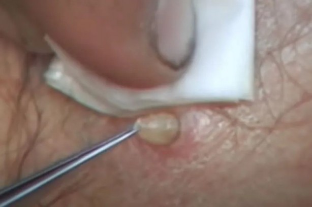 Foto - Sırtından çıkanlar görenleri şaşkına çevirdi! Sivilce zannettiği yaradan bakın ne çıktı