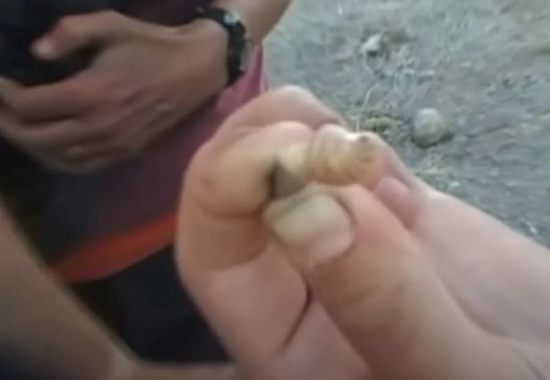 Foto - Sırtından çıkanlar görenleri şaşkına çevirdi! Sivilce zannettiği yaradan bakın ne çıktı