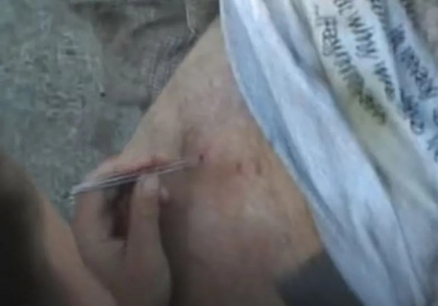 Foto - Sırtından çıkanlar görenleri şaşkına çevirdi! Sivilce zannettiği yaradan bakın ne çıktı