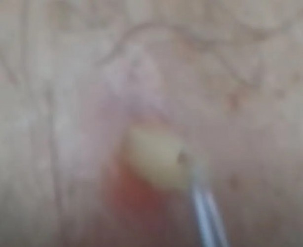 Foto - Sırtından çıkanlar görenleri şaşkına çevirdi! Sivilce zannettiği yaradan bakın ne çıktı