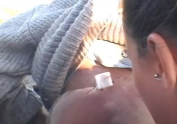 Foto - Sırtından çıkanlar görenleri şaşkına çevirdi! Sivilce zannettiği yaradan bakın ne çıktı