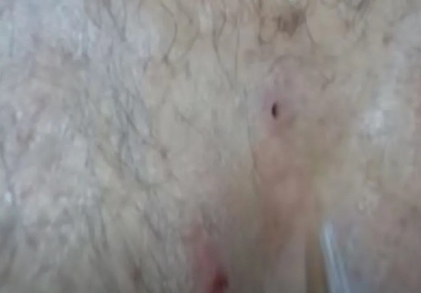 Foto - Sırtından çıkanlar görenleri şaşkına çevirdi! Sivilce zannettiği yaradan bakın ne çıktı