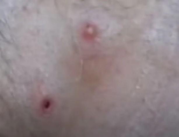 Foto - Sırtından çıkanlar görenleri şaşkına çevirdi! Sivilce zannettiği yaradan bakın ne çıktı