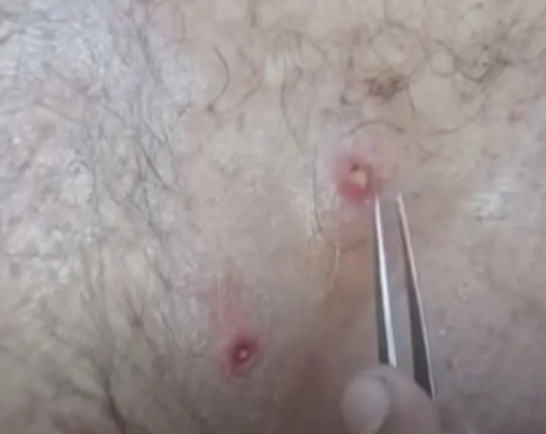 Foto - Sırtından çıkanlar görenleri şaşkına çevirdi! Sivilce zannettiği yaradan bakın ne çıktı