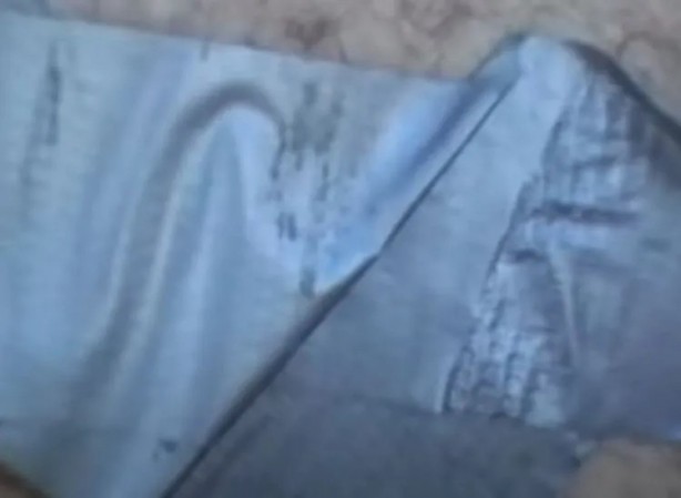 Foto - Sırtından çıkanlar görenleri şaşkına çevirdi! Sivilce zannettiği yaradan bakın ne çıktı