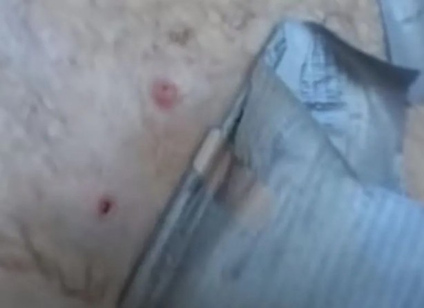 Foto - Sırtından çıkanlar görenleri şaşkına çevirdi! Sivilce zannettiği yaradan bakın ne çıktı