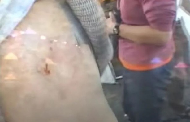 Foto - Sırtından çıkanlar görenleri şaşkına çevirdi! Sivilce zannettiği yaradan bakın ne çıktı