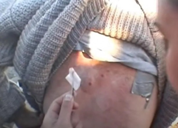 Foto - Sırtından çıkanlar görenleri şaşkına çevirdi! Sivilce zannettiği yaradan bakın ne çıktı