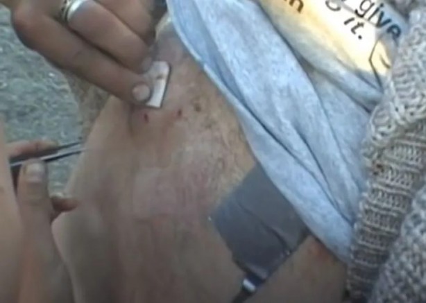 Foto - Sırtından çıkanlar görenleri şaşkına çevirdi! Sivilce zannettiği yaradan bakın ne çıktı