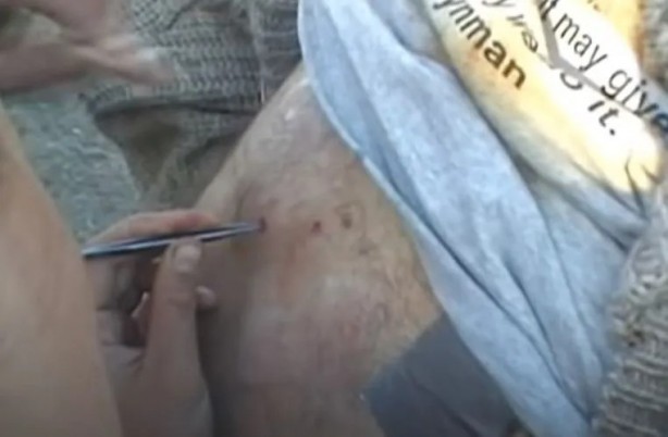 Foto - Sırtından çıkanlar görenleri şaşkına çevirdi! Sivilce zannettiği yaradan bakın ne çıktı