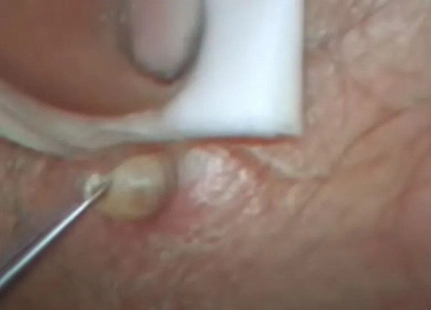 Foto - Sırtından çıkanlar görenleri şaşkına çevirdi! Sivilce zannettiği yaradan bakın ne çıktı