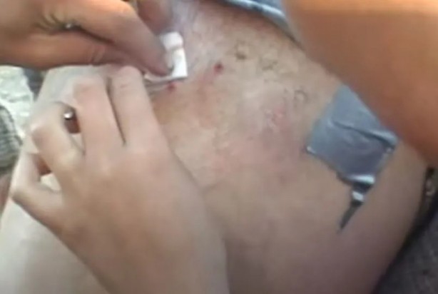 Foto - Sırtından çıkanlar görenleri şaşkına çevirdi! Sivilce zannettiği yaradan bakın ne çıktı