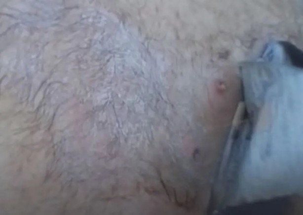 Foto - Sırtından çıkanlar görenleri şaşkına çevirdi! Sivilce zannettiği yaradan bakın ne çıktı