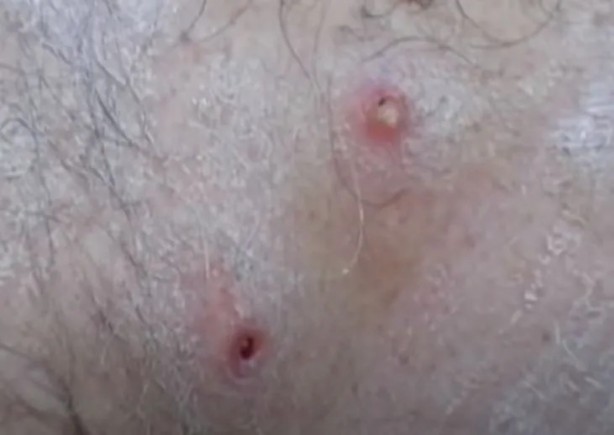 Foto - Sırtından çıkanlar görenleri şaşkına çevirdi! Sivilce zannettiği yaradan bakın ne çıktı