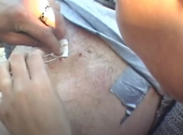 Foto - Sırtından çıkanlar görenleri şaşkına çevirdi! Sivilce zannettiği yaradan bakın ne çıktı