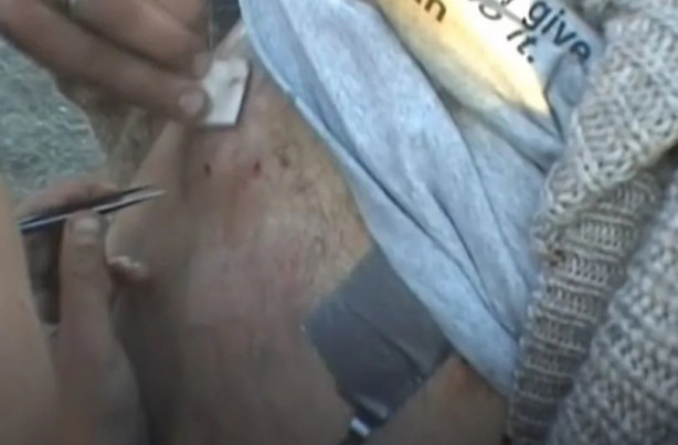 Foto - Sırtından çıkanlar görenleri şaşkına çevirdi! Sivilce zannettiği yaradan bakın ne çıktı