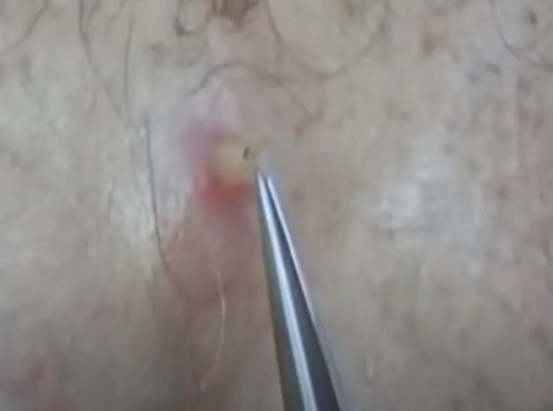 Foto - Sırtından çıkanlar görenleri şaşkına çevirdi! Sivilce zannettiği yaradan bakın ne çıktı