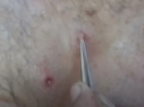 Foto - Sırtından çıkanlar görenleri şaşkına çevirdi! Sivilce zannettiği yaradan bakın ne çıktı