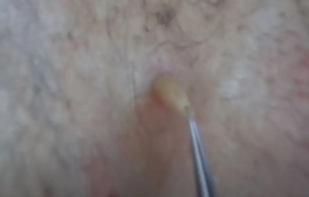 Foto - Sırtından çıkanlar görenleri şaşkına çevirdi! Sivilce zannettiği yaradan bakın ne çıktı