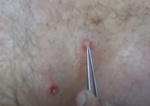 Foto - Sırtından çıkanlar görenleri şaşkına çevirdi! Sivilce zannettiği yaradan bakın ne çıktı