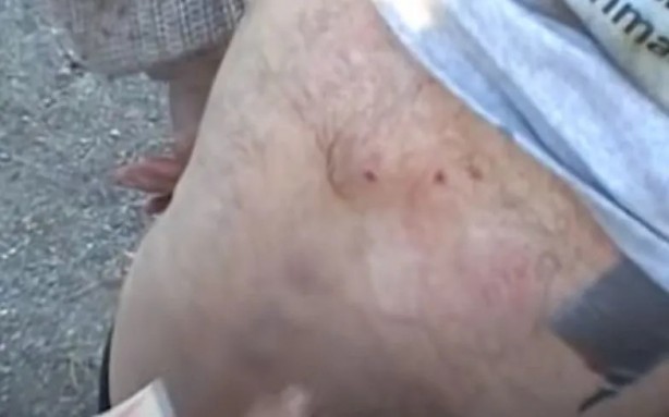 Foto - Sırtından çıkanlar görenleri şaşkına çevirdi! Sivilce zannettiği yaradan bakın ne çıktı