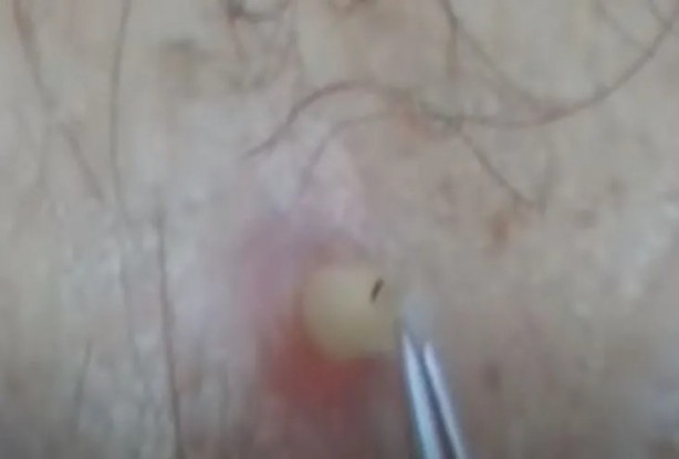 Foto - Sırtından çıkanlar görenleri şaşkına çevirdi! Sivilce zannettiği yaradan bakın ne çıktı