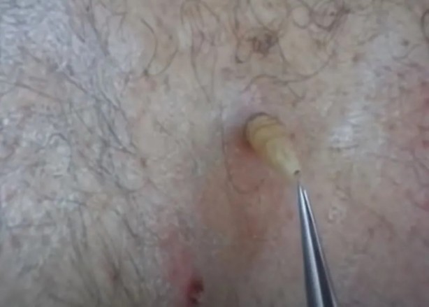 Foto - Sırtından çıkanlar görenleri şaşkına çevirdi! Sivilce zannettiği yaradan bakın ne çıktı