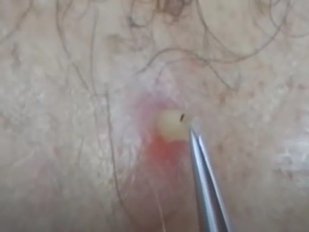 Foto - Sırtından çıkanlar görenleri şaşkına çevirdi! Sivilce zannettiği yaradan bakın ne çıktı