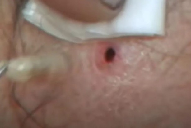 Foto - Sırtından çıkanlar görenleri şaşkına çevirdi! Sivilce zannettiği yaradan bakın ne çıktı