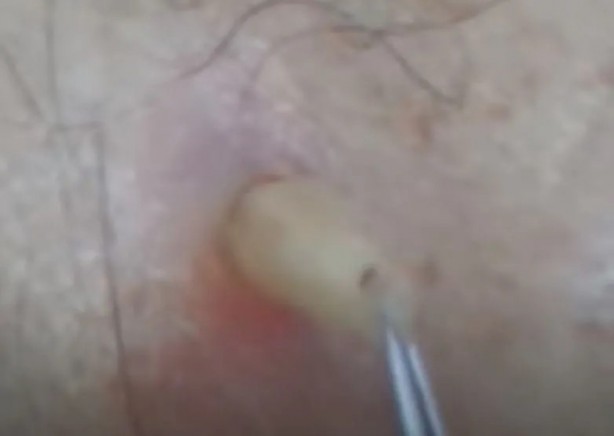 Foto - Sırtından çıkanlar görenleri şaşkına çevirdi! Sivilce zannettiği yaradan bakın ne çıktı