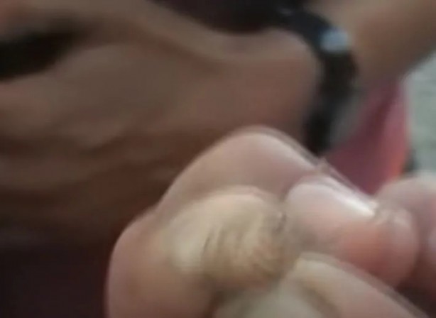 Foto - Sırtından çıkanlar görenleri şaşkına çevirdi! Sivilce zannettiği yaradan bakın ne çıktı