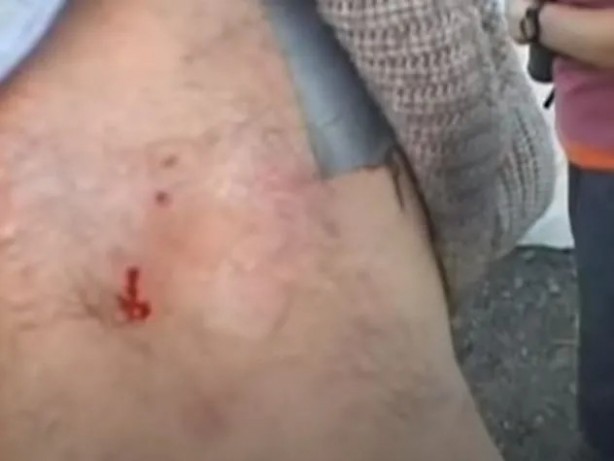 Foto - Sırtından çıkanlar görenleri şaşkına çevirdi! Sivilce zannettiği yaradan bakın ne çıktı