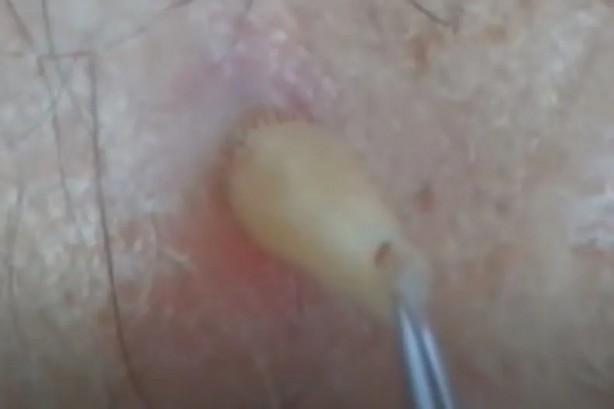 Foto - Sırtından çıkanlar görenleri şaşkına çevirdi! Sivilce zannettiği yaradan bakın ne çıktı