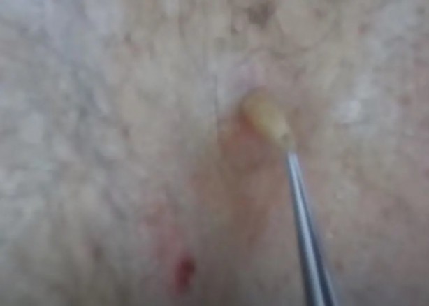 Foto - Sırtından çıkanlar görenleri şaşkına çevirdi! Sivilce zannettiği yaradan bakın ne çıktı