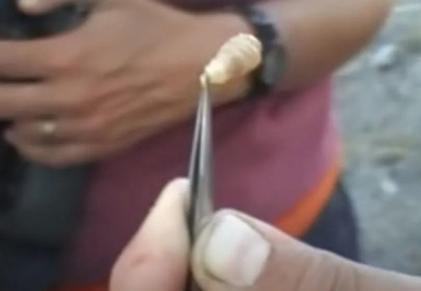 Foto - Sırtından çıkanlar görenleri şaşkına çevirdi! Sivilce zannettiği yaradan bakın ne çıktı