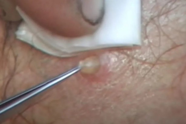 Foto - Sırtından çıkanlar görenleri şaşkına çevirdi! Sivilce zannettiği yaradan bakın ne çıktı