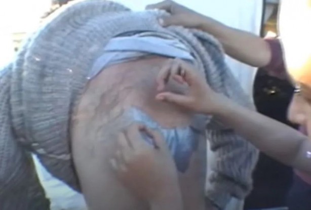 Foto - Sırtından çıkanlar görenleri şaşkına çevirdi! Sivilce zannettiği yaradan bakın ne çıktı